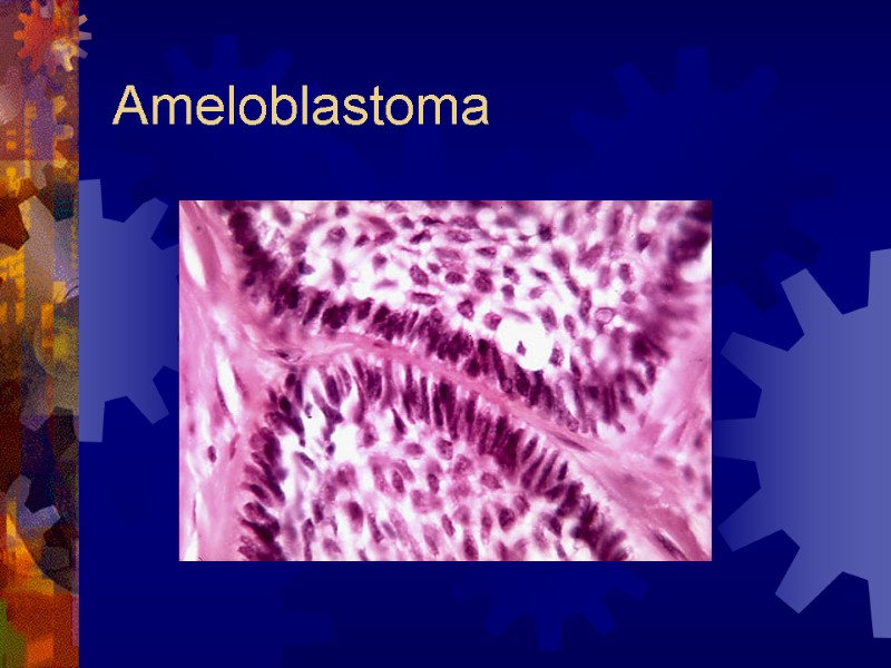 Ameloblastoma